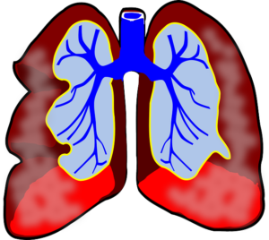 płuca osoby z chorobą płuc